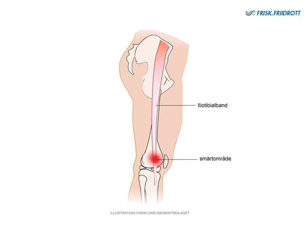 Löparknä (iliotibalband syndrom - ITBS) 
