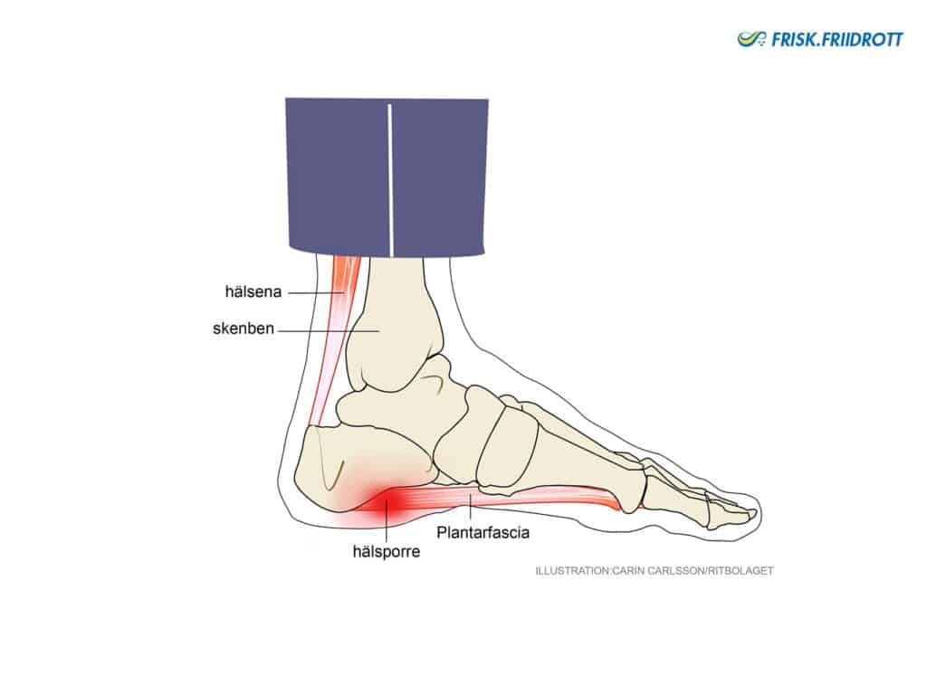 Hälsporre (plantarfascia) 