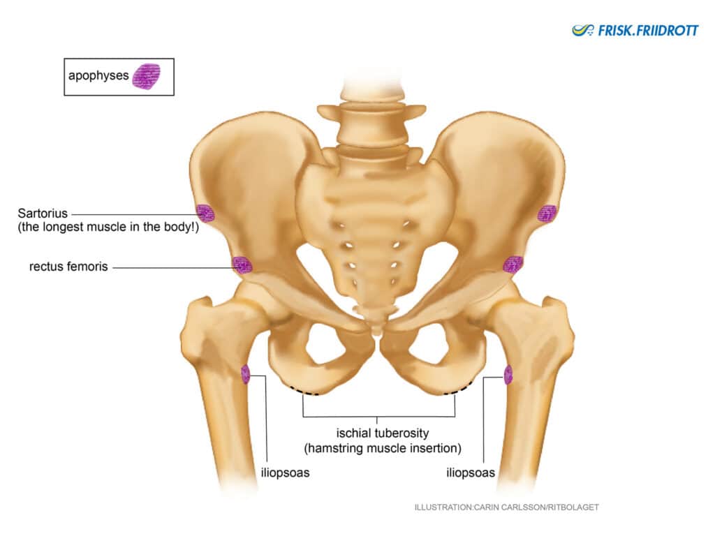 Apophyseal overload at the hip, groin and pelvis