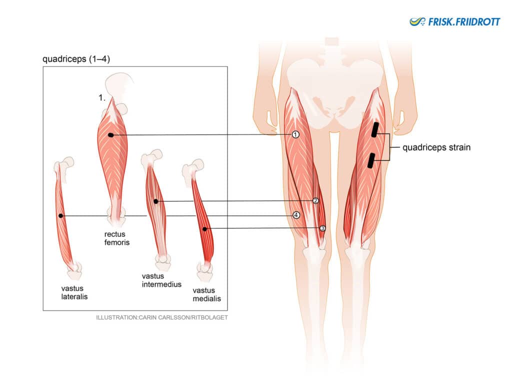 Quadriceps rupture (muscle rupture of the muscle group at the front of the thigh)