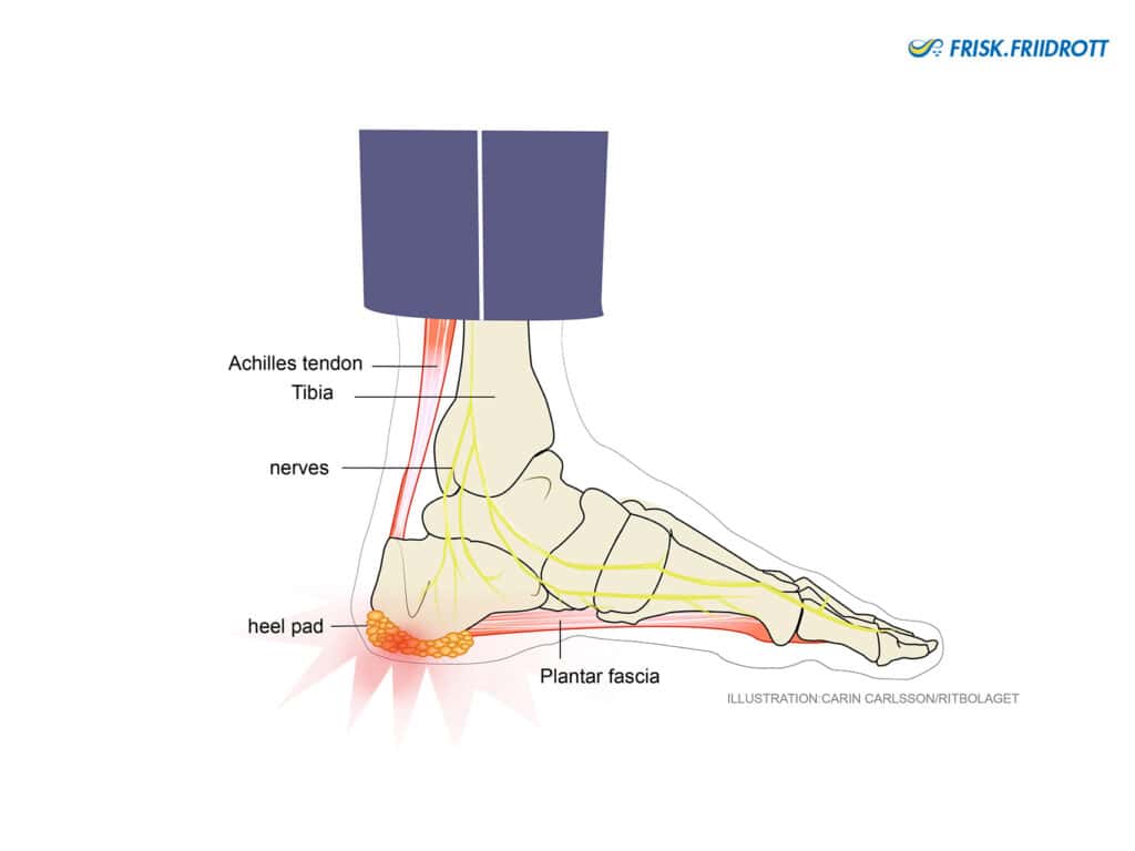 Heel pad syndrome 