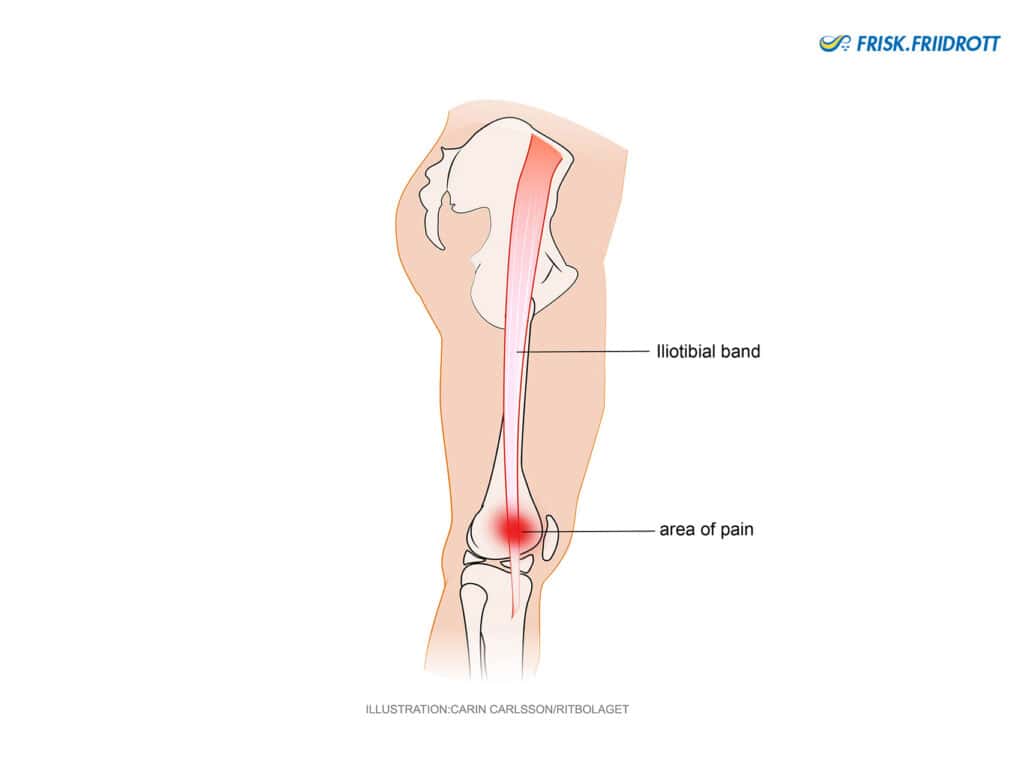 Runner’s knee (iliotibial band syndrome – ITBS)