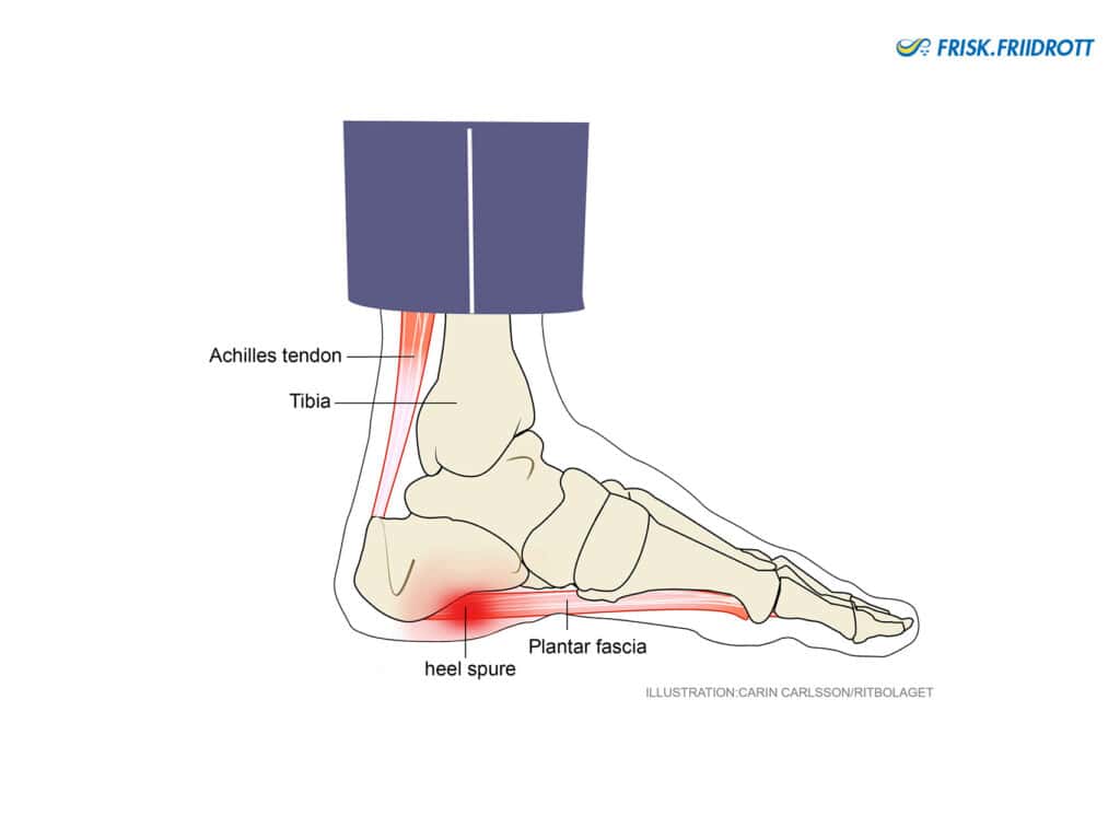 Heel spur (plantar fascia pain)