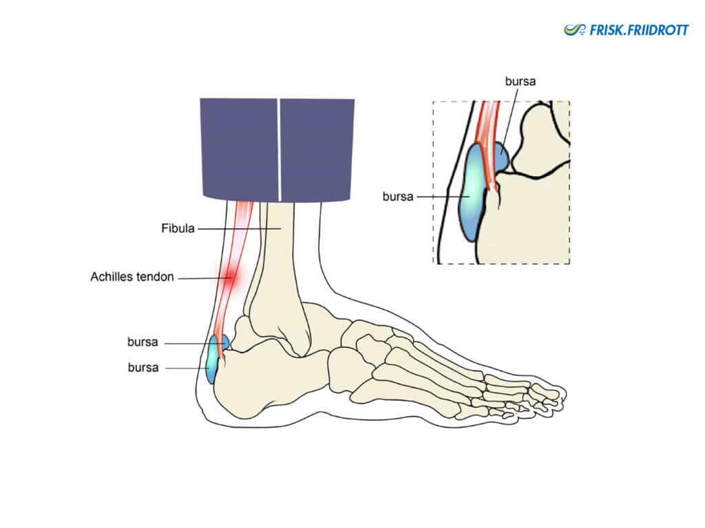 Mid portion Achilles pain