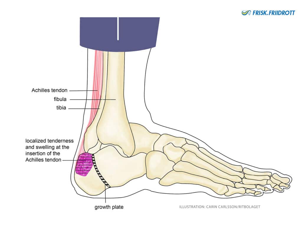 Haglunds heel-calcaneal apophysitis (also called Sever’s disease)