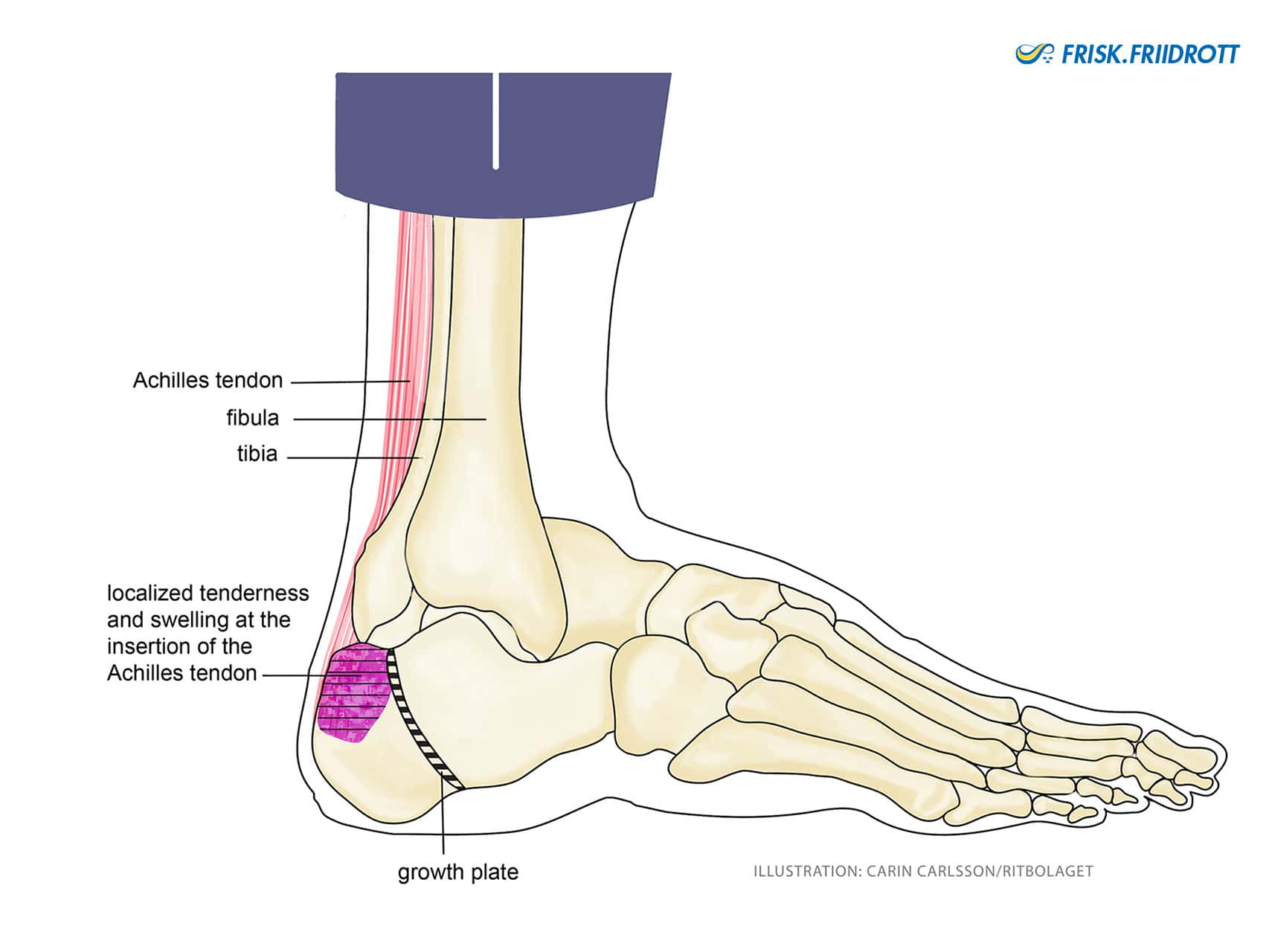 Broken Heel Bone - Calcaneus Fracture — Bone Talks