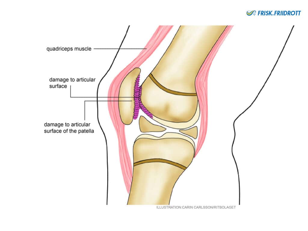 Chondromalacia Patellae/Anterior knee pain