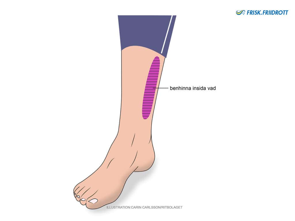 Benhinneinflammation-Tibiaperiostit