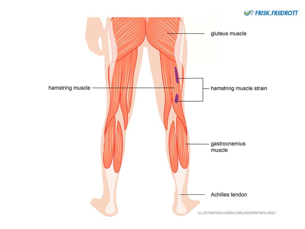 Hamstring strain