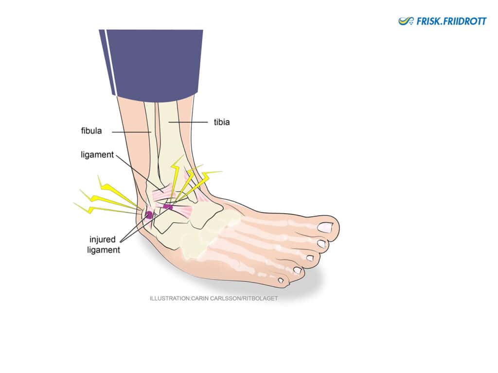 Ankle sprain