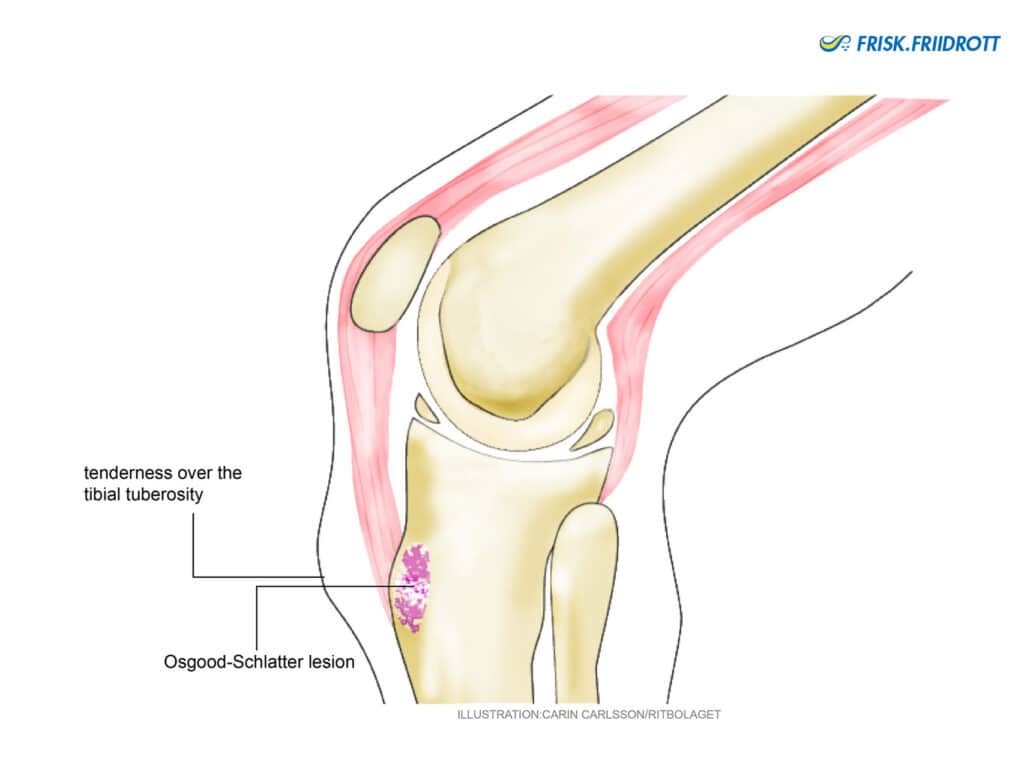 Osgood-Schlatter’s disease