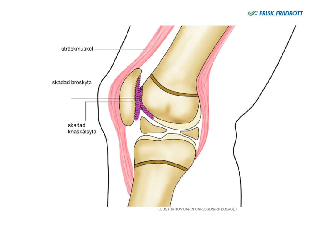 Chondromalacia Patellae