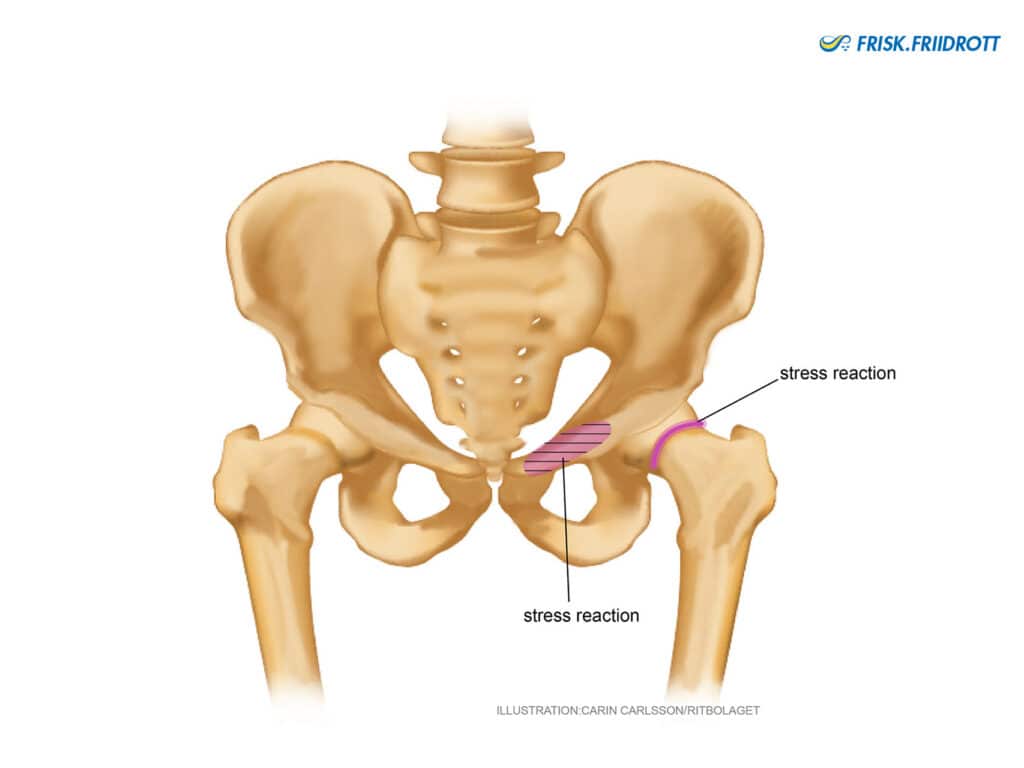 Stress fracture-stress reaction in the groin