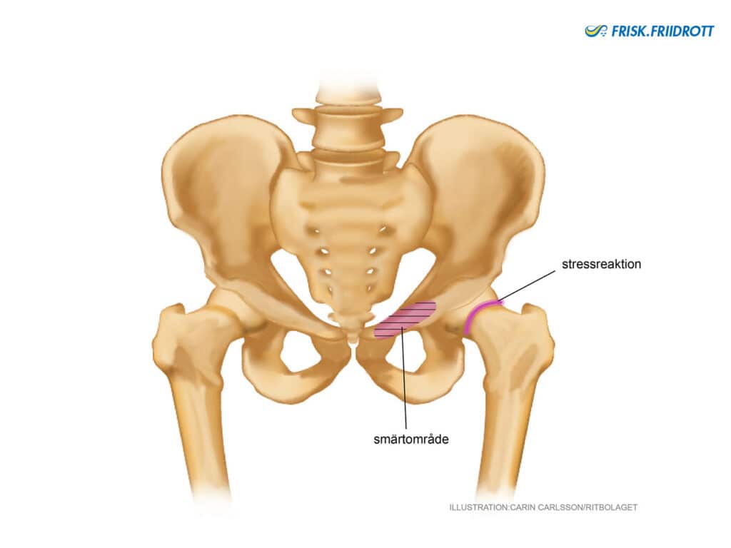Stressfrakturer-insuffiensfrakturer i ljumsktrakten