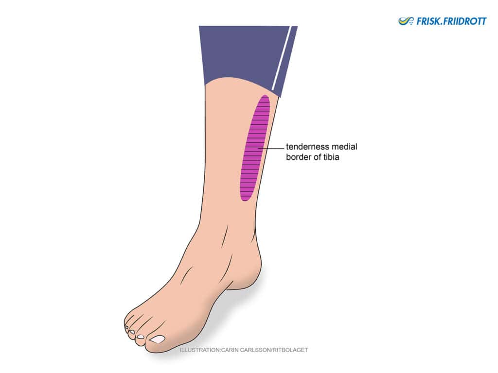 Medial tibial stress syndrome (MTSS)- Shin splints.