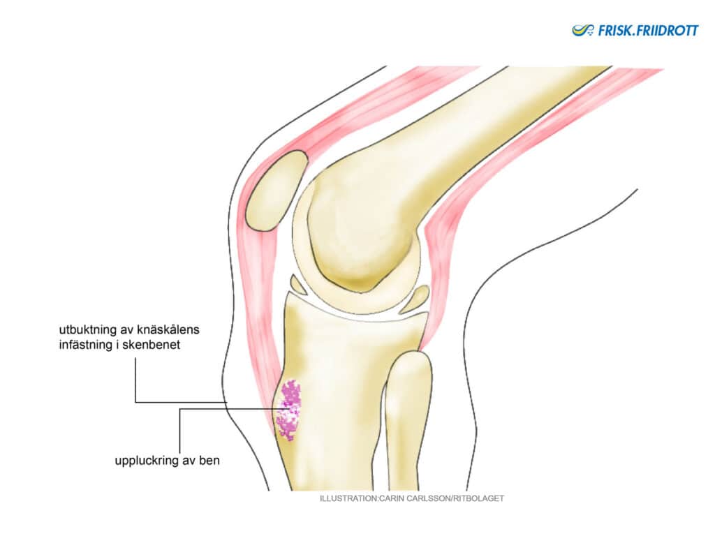 Morbus Schlatter