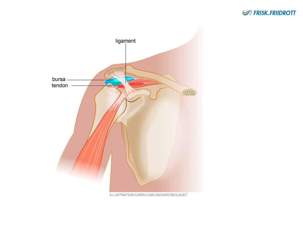 Shoulder impingement